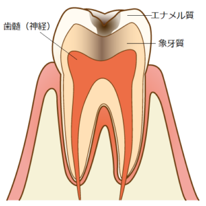 虫歯の治療③ 象牙質の虫歯【C２】 u2013 清瀬いんどう歯科｜清瀬市松山の 